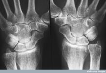 Rheumatoid Arthritis: The Challenges of Predicting Response to Treatment