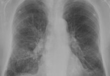 The Ethics of Pharmaceutical Companies in the Treatment of Severe Asthma