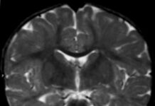 Promising treatment for Alexander disease