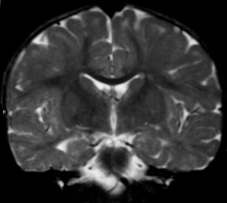 Promising treatment for Alexander disease