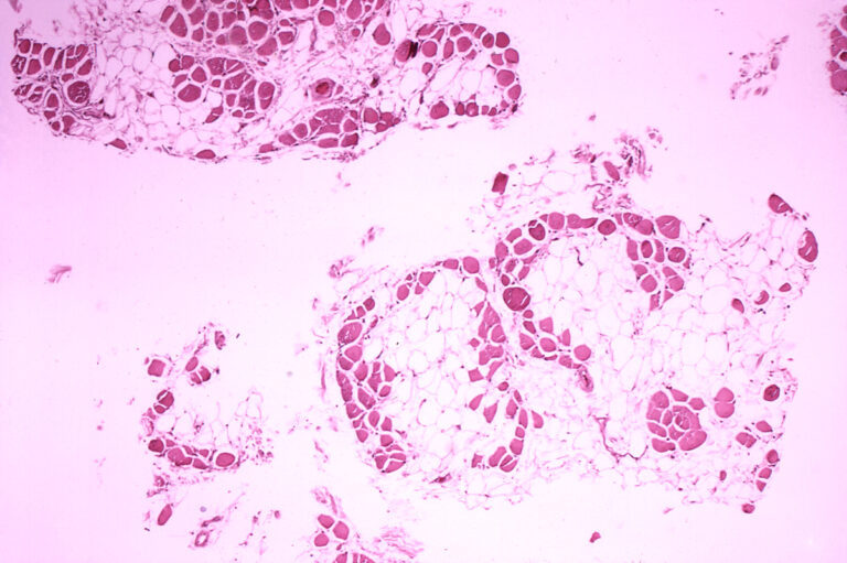 Promising Therapy for Treating Fatal Genetic Disorder ￼